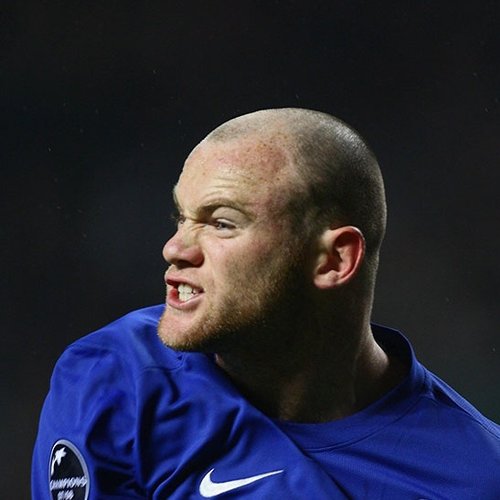 Before hair transplant