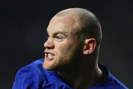 Before hair transplant