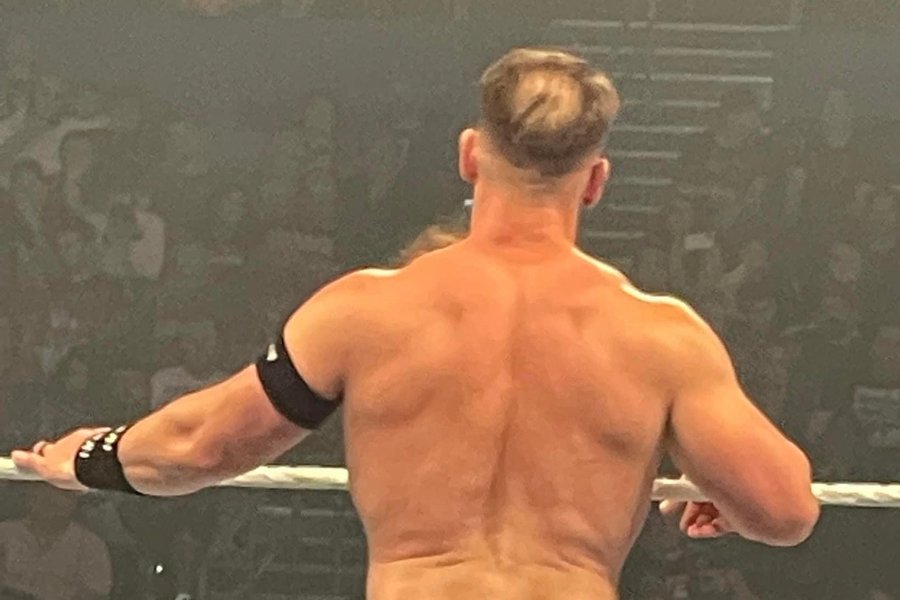 Before hair transplant