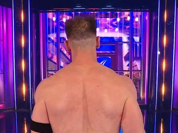 Overall crown coverage appears more balanced in post-2024 appearances, with reduced scalp contrast compared to earlier live-event imagery.