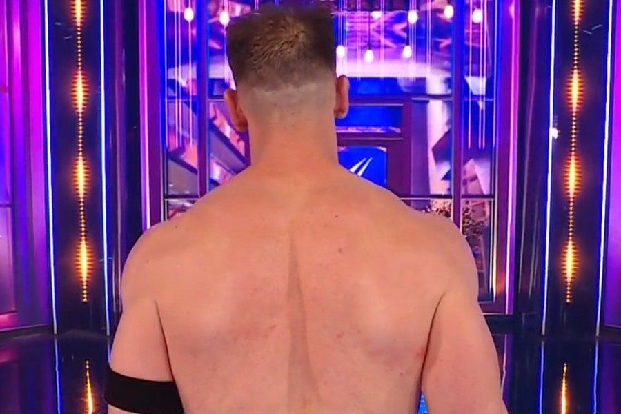 After hair transplant