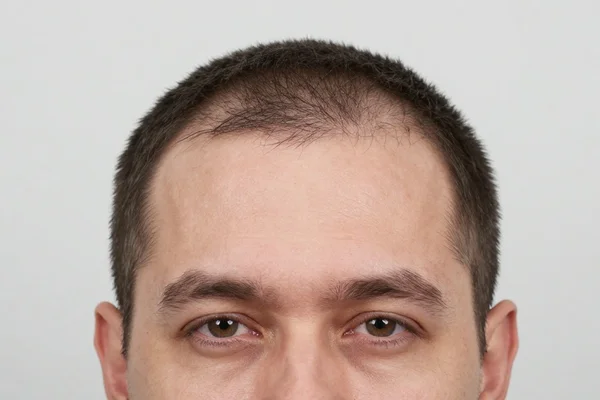 Hairline (Frontal Zone)