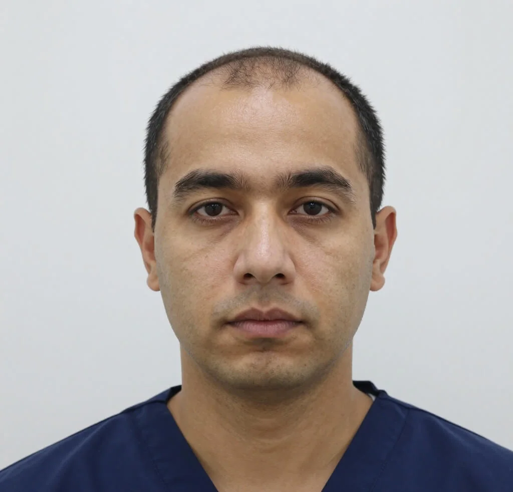 Before hair transplant