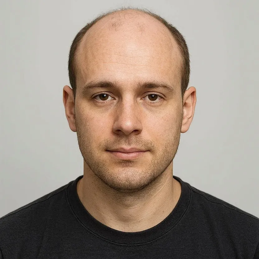 Before hair transplant simulation